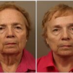 Case Study: Lower Facelift Results and Benefits