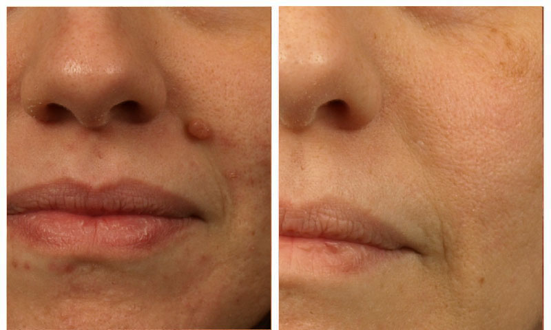 Close up on Mole Removal - Mole Lesion Removal for Clear, Healthy Skin