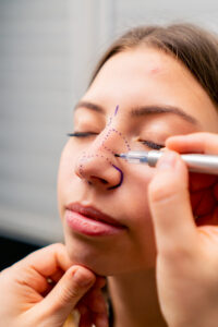 close-up Rhinoplasty surgeon makes marks on a patient's face during a consultation